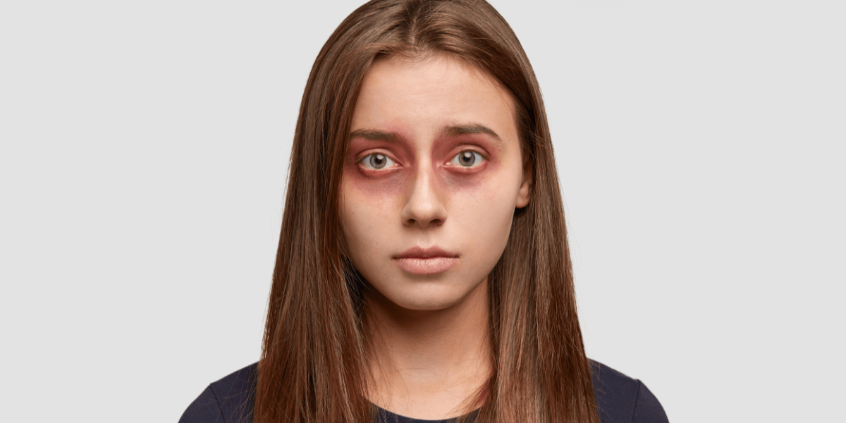 5 Simple Ways to Get Rid of Tired Eyes